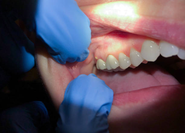 Best Emergency Gum Treatment in Chandler, TX