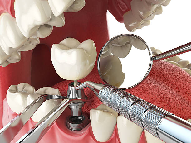 Best Emergency Dental Care for Broken or Chipped Teeth in Chandler, TX